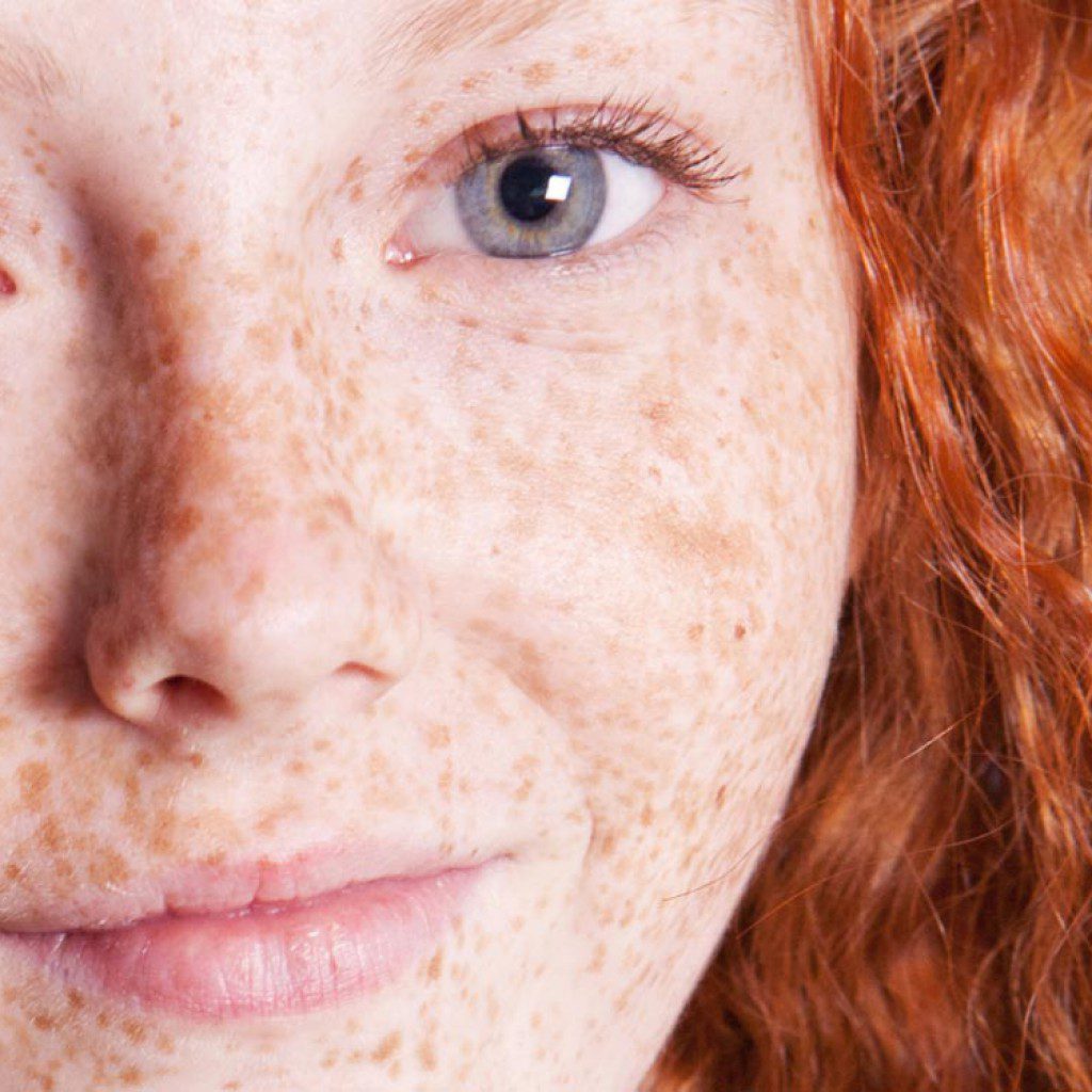 Freckles And Sun Damage Radien Dermatology