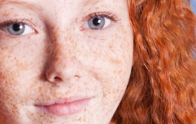 Kids Health: What Are Freckles?