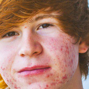 Radien Dermatology - Acne