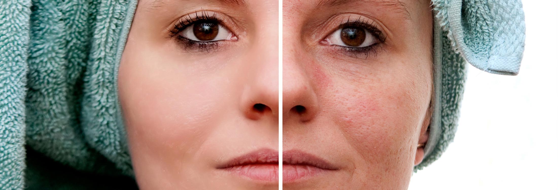 Radien Dermatology - Acne Scarring