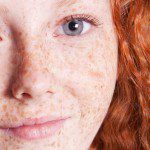 Radien Dermatology - Freckles and Sun Damage