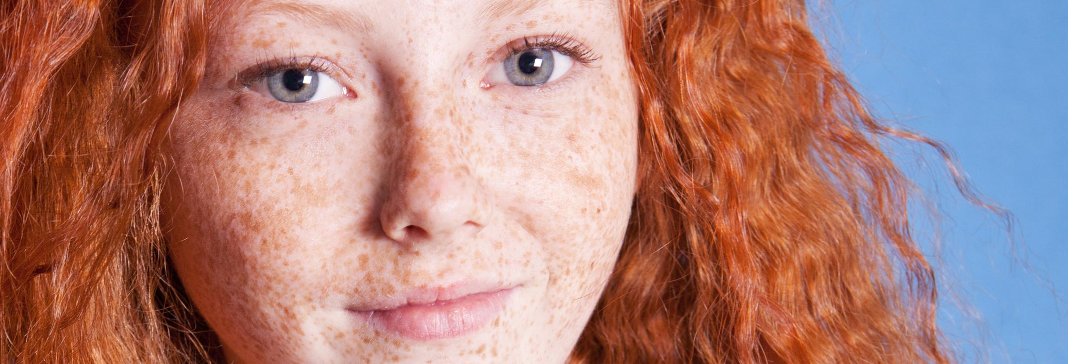 Radien Dermatology - Freckles and Sun Damage