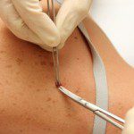 Surgical Dermatology Excise