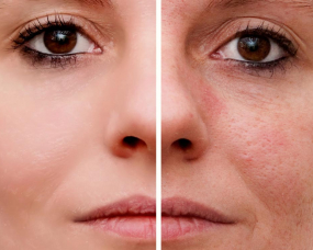 Acne Scarring
