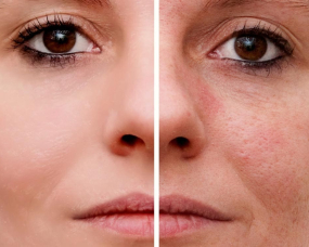 Acne Scarring Acne Scarring