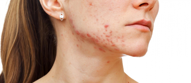 Acne and Acne Scarring