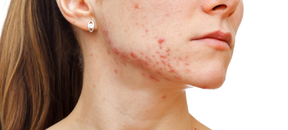 Acne and Acne Scarring