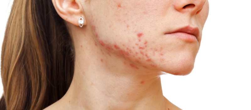 Radien-Dermatology-Acne-and-Acne-Scarring Acne and Acne Scarring