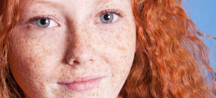 Freckles and Sun Damage - Radien Dermatology