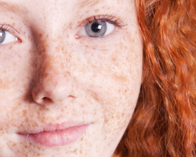 Freckles and Sun Damage