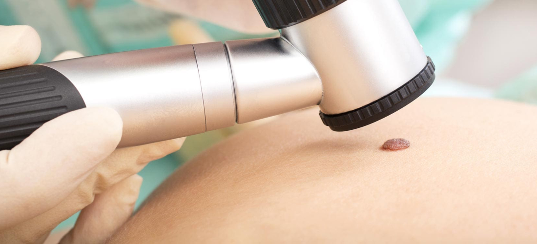 Lesion Removal Lesion Removal