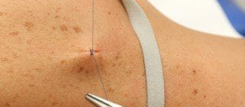 Surgical Dermatology Closing Surgical Dermatology Closing
