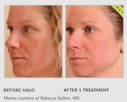 HALO FRACTIONAL LASER HAS ARRIVED AT RADIEN